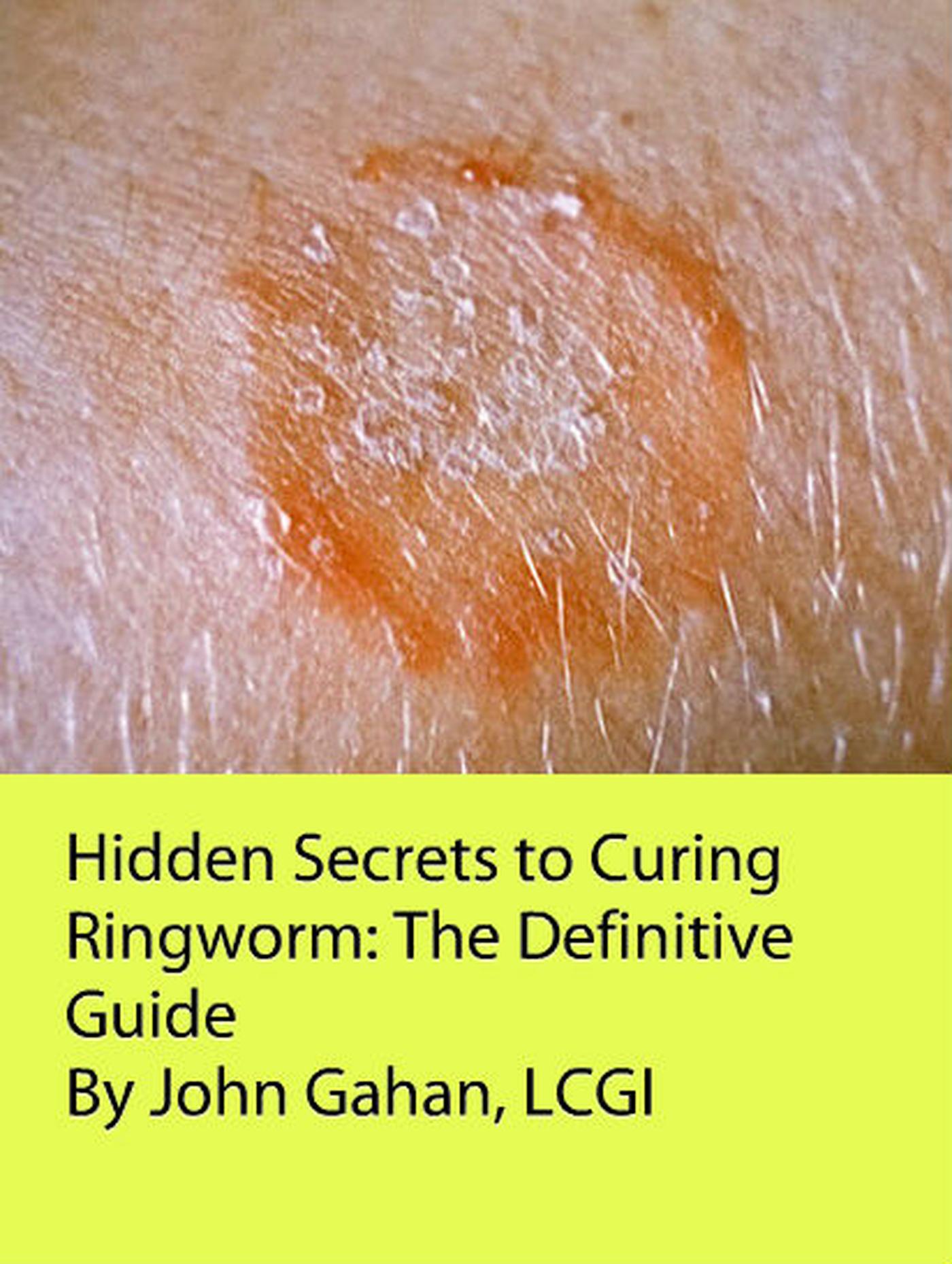 Smashwords Hidden Secrets To Curing Ringworm The Definitive Guide smashwords-hidden-secrets-to-curing-ringworm-the-definitive-guide